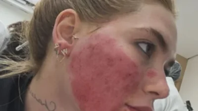 Virginia Show: Horror na Pele Após Tratamento Estético!