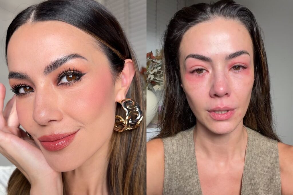 Influencer em choque! Vídeo INÉDITO mostra rosto irreconhecível após crise alérgica