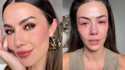 Influencer em choque! Vídeo INÉDITO mostra rosto irreconhecível após crise alérgica